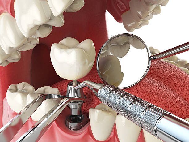 Best Emergency Root Canal Treatment in Beverly Hills, MI